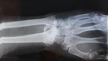 detall d'una radiografia de mà 