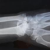 detall d'una radiografia de mà 
